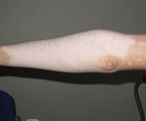 肢端型白癜风病因有哪些