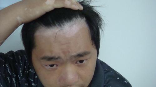 北京治疗白癜风医院：男性如何预防白癜风的出现