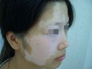 北京治疗白癜风医院：预防面部出现白斑的方法