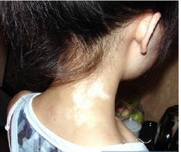 北京治疗白癜风医院：颈部白癜风有哪些症状表现